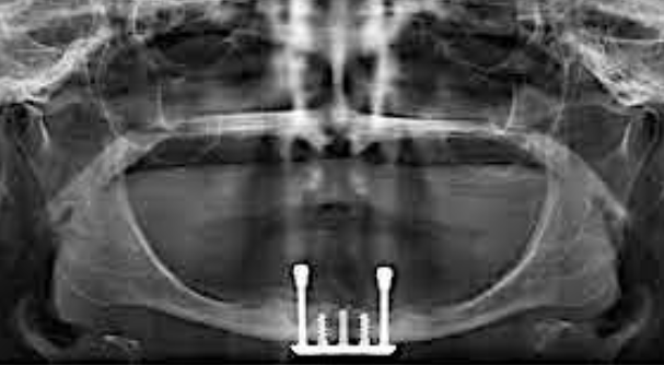 <p><span>Consists of a horizontal beam attached to metal rods and inserted all the way through the mandible from superior border to the inferior border</span></p><p><span>• Seldom used due to its </span><span style="color: rgb(255, 0, 0);">highly invasive nature</span></p><p><span>• Most commonly used to support<br>a mandibular denture with </span><span style="color: rgb(255, 0, 0);">severe resorption</span></p>
