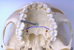 <p>maxillae and palatine bones</p>