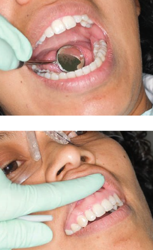 <ul><li><p>Using mirror head to hold soft tissue out of the way</p></li></ul><p></p><p><strong>Retraction of tongue </strong></p><ul><li><p>Using mirror head to hold patient’s cheek, lip, tongue to view tooth surfaces</p></li></ul><p></p><p><strong>Retraction of lip</strong></p><ul><li><p>Index finger of non dominant hand retract lip away from facial aspect of anterior teeth </p></li><li><p>Finger is more comfortable than mirror</p></li><li><p>Mirror may be held in palm of hand when retracting with finger — avoids putting down mirror</p></li></ul><p></p>