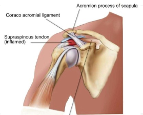 <p><span style="background-color: transparent;"><strong>What is the name of the injury shown in the picture below?</strong></span></p>