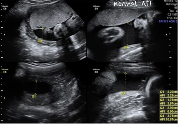 <ul><li><p>10 cm < AFI < 20 cm</p><ul><li><p>should be <span style="color: red;">between 10-20 cm</span></p></li></ul></li></ul><p></p>