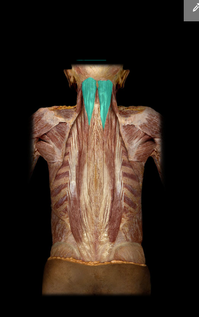 <p>Semispinalis capitis m.</p>