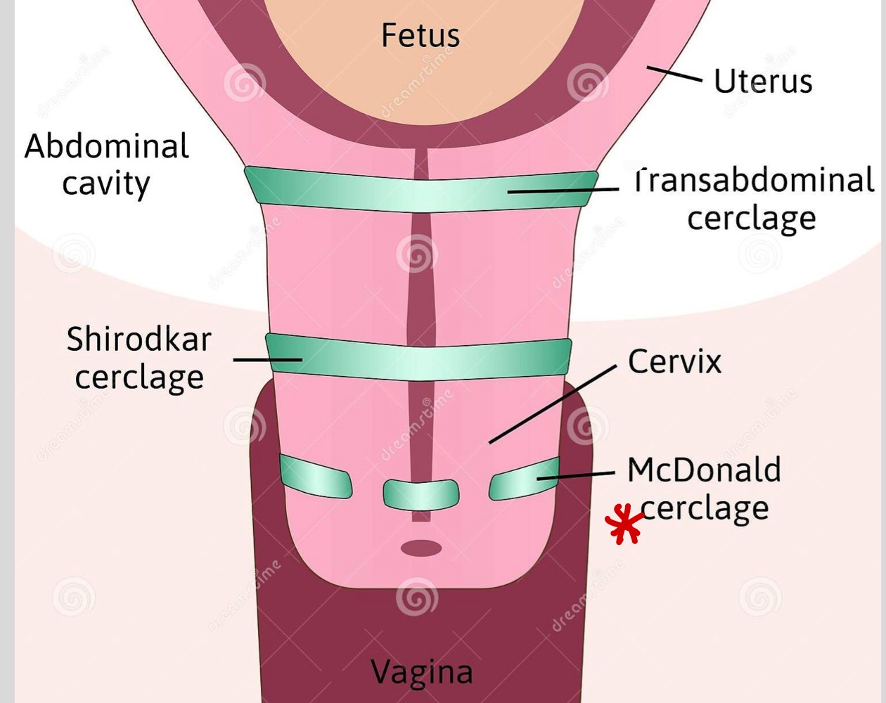 <p>McDonald, Shirodkar, Abdominal</p>
