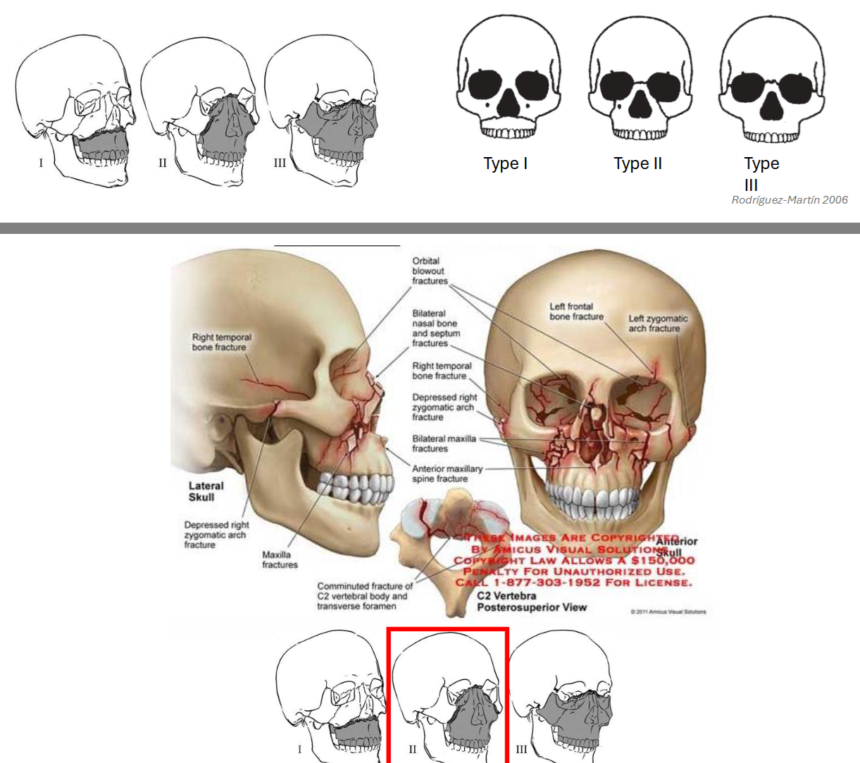 <p>Facial Fractures</p>