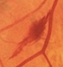 <p>What hemorrhages are visualized with hypertensive retinopathy?</p>