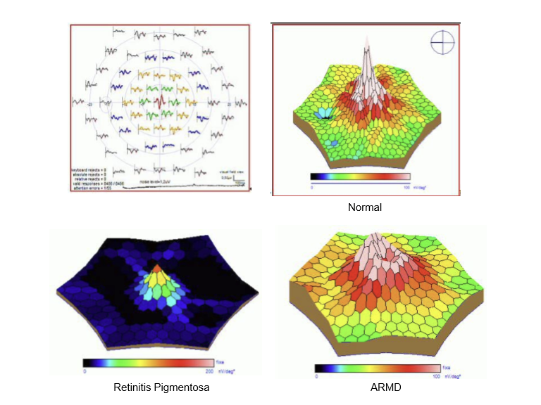 <p>mfERG presents an array of ~240 hexagonal elements that flicker on/off in a pseudorandom pattern (about half illuminated at any time).<br>An algorithm extracts local ERG responses for each hexagon.<br>→ Provides a topographic map of retinal function across the posterior pole.</p>