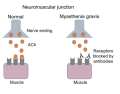 <p>results in both destruction of the receptors as well as blocking of the Ach binding sites</p>