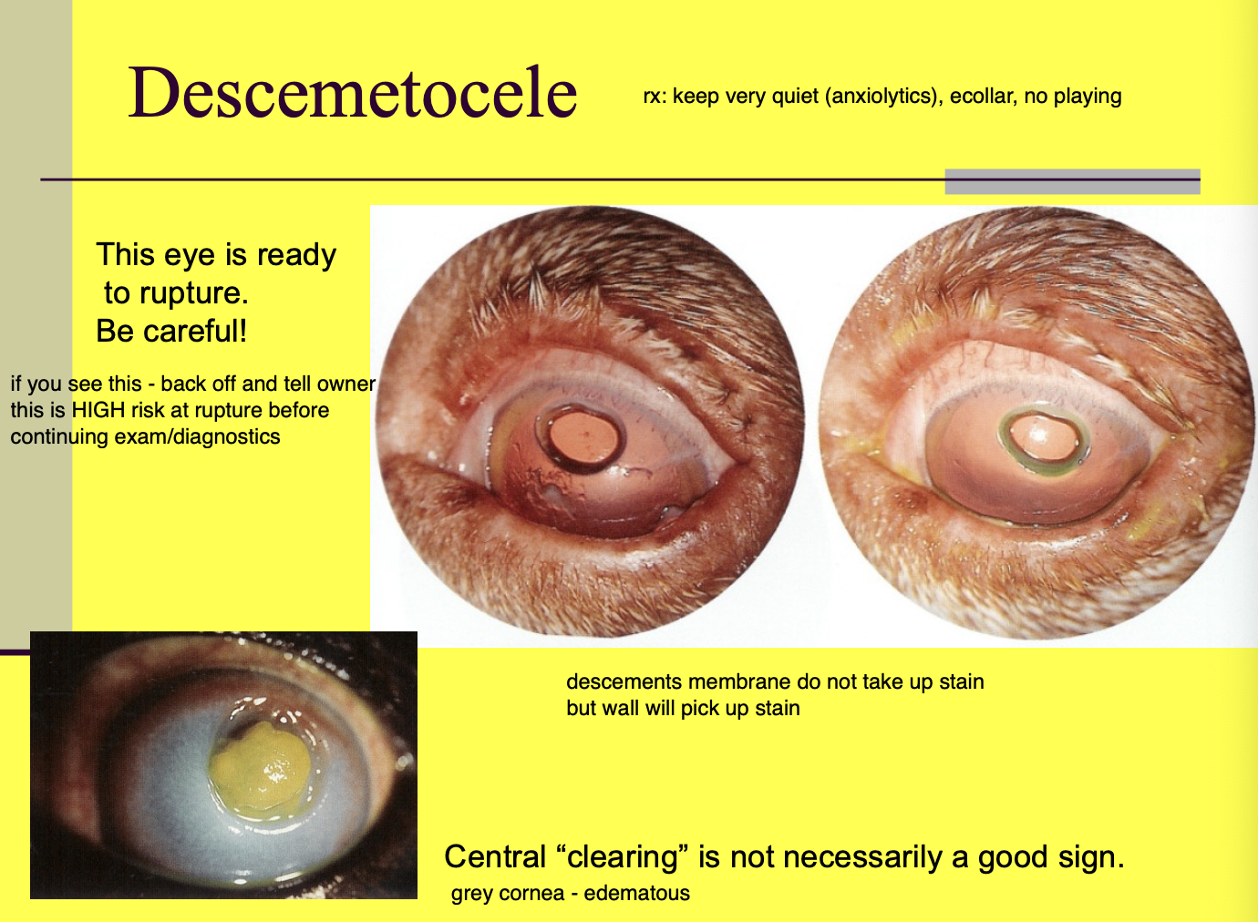 <p>Ulcer that is down to descemet's membrane (central clearing is not a good sign). </p><p>High risk for rupture!</p>