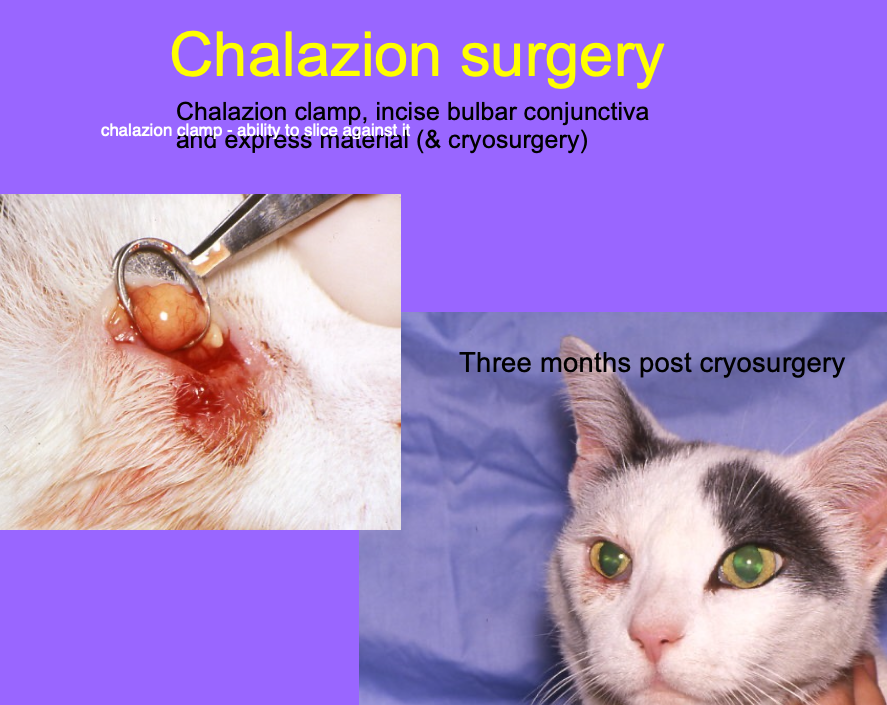 <p>Chalazion clamp.</p><p>Incise bulbar conjunctiva and express material.</p><p>Cryosurgery.</p>
