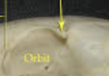 <p>The ______ _______ _______ is the process (point) above the orbital.</p>