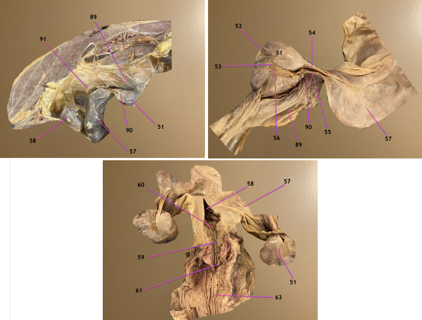 <p>pic 1: female repro tract in situ</p><p>pic 3: dorsal view of repro tract</p><p>.</p><p>label the CT 89-91</p>