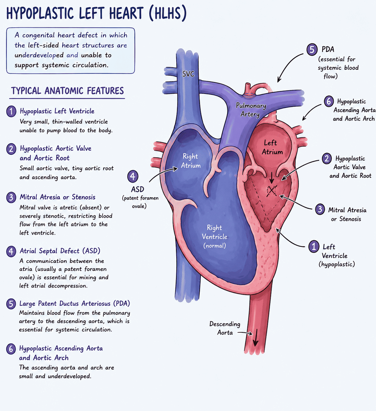 <p>hypoplastic left heart</p>