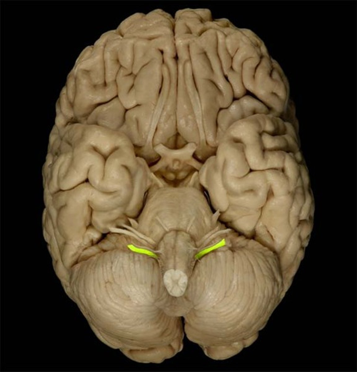 <p>Name: </p><p>Vagus</p><p>Sensory or Motor:</p><p>Both</p><p>Key Functions:</p><p>Voice, swallowing, parasympathetic </p><p>Symptoms:</p><p>Hoarseness, uvula deviates away</p><p>Clinical:</p><p>Efferent gag reflex </p>