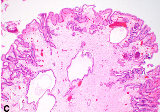 <p>Polype gastrique</p><p>1) Diagnostic</p><p>2) Localisation, fréquence et contexte </p><p>3) histologie</p><p>4) A rechercher </p>