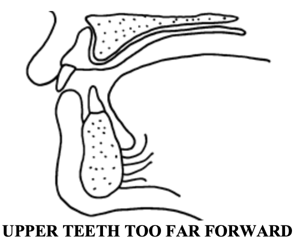 <p>Speech problems help the doc identify tooth-positioning errors. What if the maxillary teeth are set too far forward?</p>