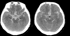 <p>b/w arachnoid and pia mater</p>