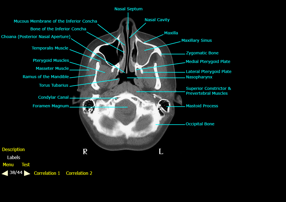 <ol><li><p>Occipital Bone</p></li><li><p>Mastoid Process</p></li><li><p>Superior Constrictor & Prevertebral Muscle</p></li><li><p>Nasopharynx</p></li><li><p>Lateral Pterygoid Plate</p></li><li><p>Medial Pterygoid Plate</p></li><li><p>Zygomatic Bone</p></li><li><p>Maxillary Sinus</p></li><li><p>Maxilla</p></li><li><p>Nasal Cavity</p></li><li><p>Nasal Septum</p></li><li><p>Mucous Membrane of the Inferior Concha</p></li><li><p>Bone of the Inferior Concha</p></li><li><p>Choana</p></li><li><p>Temporalis Muscle</p></li><li><p>Pterygoid Muscle</p></li><li><p>Masseter Muscle</p></li><li><p>Ramus of the Mandible</p></li><li><p>Torus Tubarius</p></li><li><p>Condylar Canal</p></li><li><p>Foramen Magnum</p></li></ol><p></p>