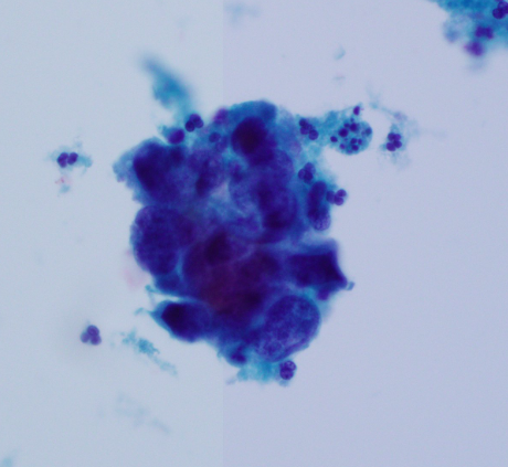 <p>Pap smear: The lesion on the image is best classified as: </p>