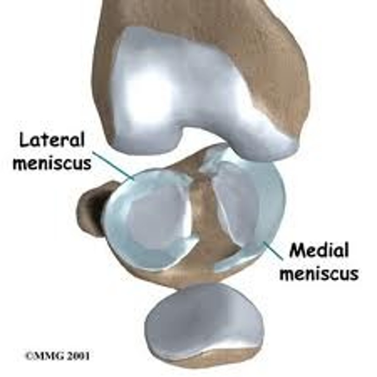 <p>Crescent-shaped pieces of fibrocartilage located on the tibial plateau. The menisci help to distribute the forces across the knee joint and provide stability to the joint. The medial meniscus is larger and more C-shaped, while the lateral meniscus is more circular. The menisci help to stabilize the joint by guiding the condyles during flexion, extension, and rotation movements and preventing side-to-side rocking of the femur on the tibia.</p>