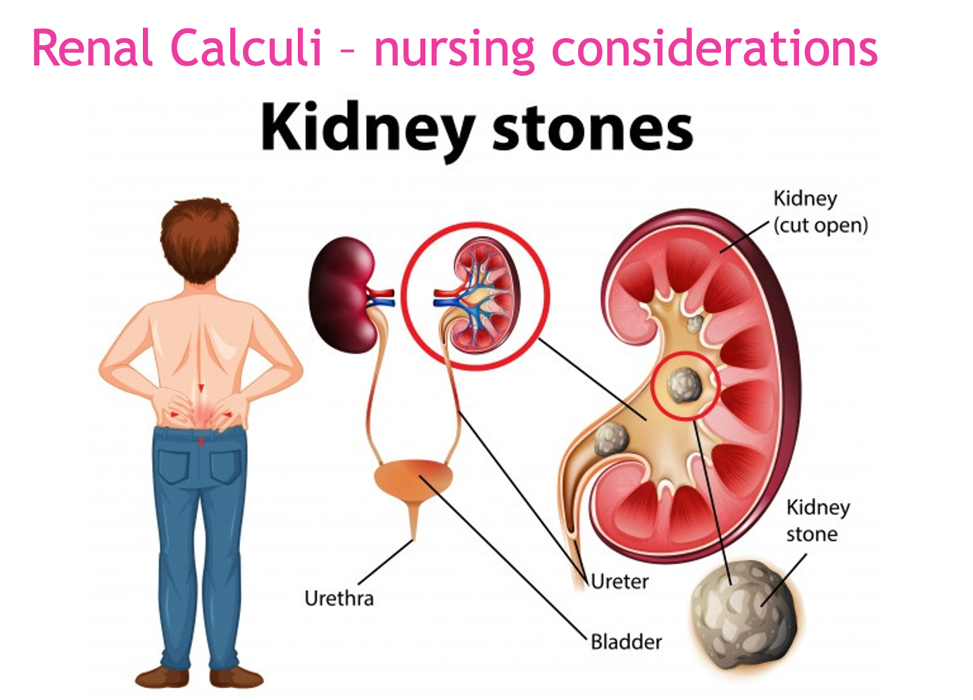 <ul><li><p>Assessment </p><ul><li><p>Pain </p></li><li><p>Signs of obstruction - dysuria, hematuria, frequency/oliguria </p></li><li><p>Fever and chills </p></li><li><p>N/V </p></li><li><p>Diaphoresis + pallor </p></li><li><p>Elevated HR, RR, and BP </p></li></ul></li><li><p>Nursing Interventions </p><ul><li><p>Provide analgesic therapy: opioids, NSAIDS, heat therapy to low back/flank area </p></li><li><p>Increase fluid intake, unless contraindicated; avoid activities that may cause sweating </p></li><li><p>Monitor for S/S of UTI and for blood/stones in urine (save stones for lab analysis) </p><ul><li><p>Stones in the renal pelvis may be associated with an intense, deep ache in the costovertebral region </p></li><li><p>Stones lodges in the ureter (ureteral obstruction) cause acute, excruciating, colicky, wavelike pain that radiates down the thigh and to the genitalia </p></li></ul></li><li><p>Monitor I&amp;O for oliguria/anuria </p></li><li><p>Draw + monitor ordered labs </p><ul><li><p>Blood chemistries and a 24-hour urine test for measurement of calcium, uric acid, creatinine, sodium, pH, and total volume may be part of the diagnostic workup </p></li></ul></li><li><p>Dietary restrictions: foods high in protein, sodium, or oxalate</p><ul><li><p>Sodium competes with calcium for reabsorption in the kidneys </p></li><li><p>Maintain daily recommendation of calcium, don’t restrict since it can lead to osteoporosis </p></li></ul></li></ul></li><li><p>Medical procedures may be ureteroscopy, lithotripsy, or nephrolithotomy </p></li></ul><p></p>