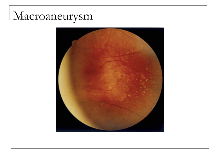 <p>Most common in ages 50–80.<br>~50% have systemic hypertension.</p>