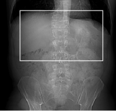<p>Start location: Just above diaphragm End location: Just below kidney</p>