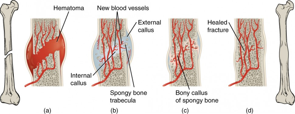 <p>Stages in fracture repair </p>
