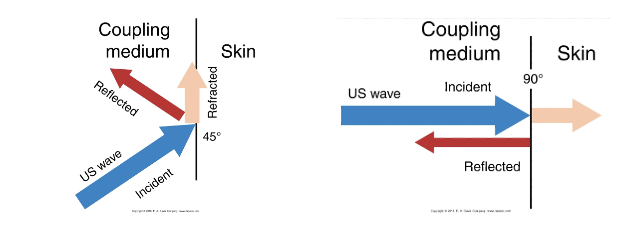 <p>if we don’t have a coupling medium, waves are refracted and don’t go into skin, vs if you do have a coupling medium, skin absorbs waves</p><p>sound head</p><ul><li><p>perpendicular to the skin, not at an angle </p></li><li><p>absorption of US waves </p></li><li><p>machine should not be turned on until it’s ready to go → prepped with gel and in position</p></li></ul><p></p>