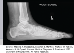 <p>X-ray: Must be weight-bearing</p>