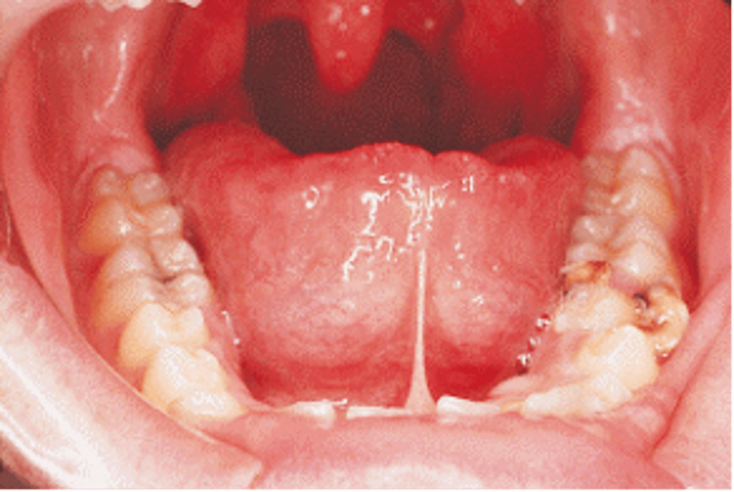 <p><span>Significant adhesion of the tongue to the floor of the mouth caused by a short lingual frenum is called?</span></p><p>developmental anomaly characterized by a shortened lingual frenum that limits movement of the tongue.</p><p>Can cause speech problems, periodontal defects, and problems with breast feeding.</p><p>More common in males</p>