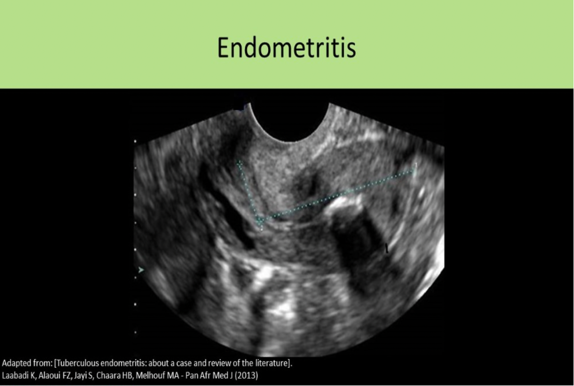<p>A. Endometritis</p><p>4 Stages of PID: PID is an ascending infection, starts in uterus and moves upward into tubes/ovaries</p><p class="p1">Acute endometritis, endometrial fluid/debris/air, fluid in posterior cul-de-sac Acute salpingitis, fluid or pus within tubes, "shaggy" appearance of tube walls</p><p class="p1">Acute tubo-ovarian abscess</p><p class="p1">Chronic Infection</p>