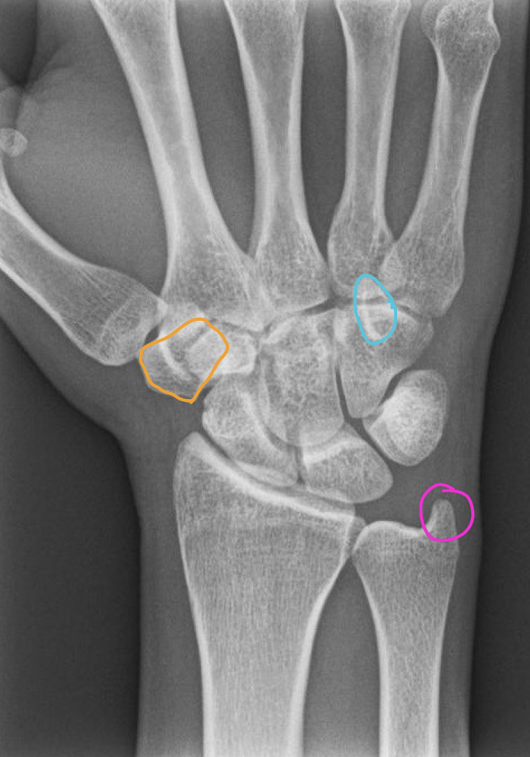<p>What are in each of the circles in this PA wrist image</p>