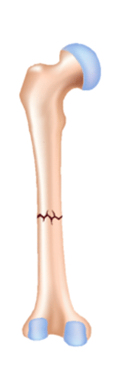 <p>bone fracture that runs laterally or side to side</p>