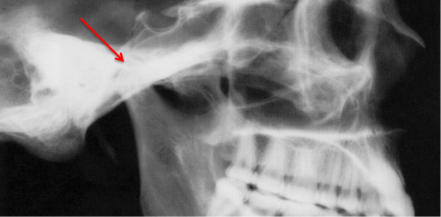 <p>which anatomical landmark:</p><p>- Most superior point of the condyle</p><p>- Should be immediately anterior to Porion</p>