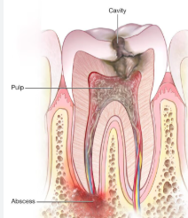 <p>Around apex of tooth</p>