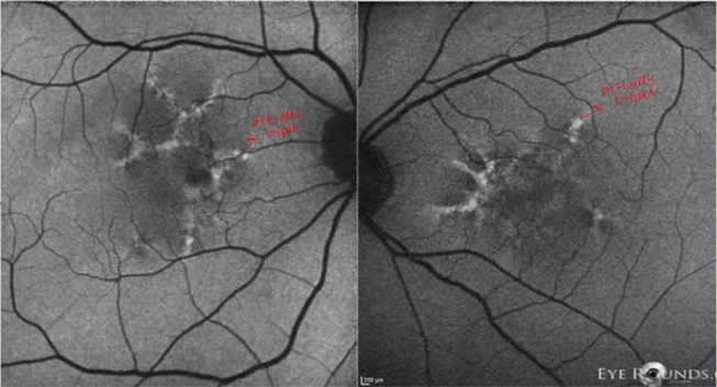 <p>hyper OU; increased lipofuscin </p><p>due to RPE issue; doesn’t get rid of waste and it accumulates </p>