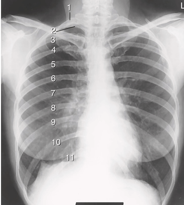 <p>is this a good PA chest</p>