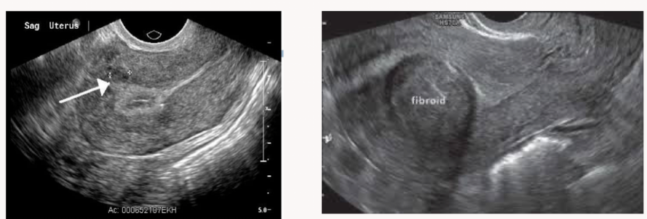 <p>Which patient is likely to have fertility problems?</p>