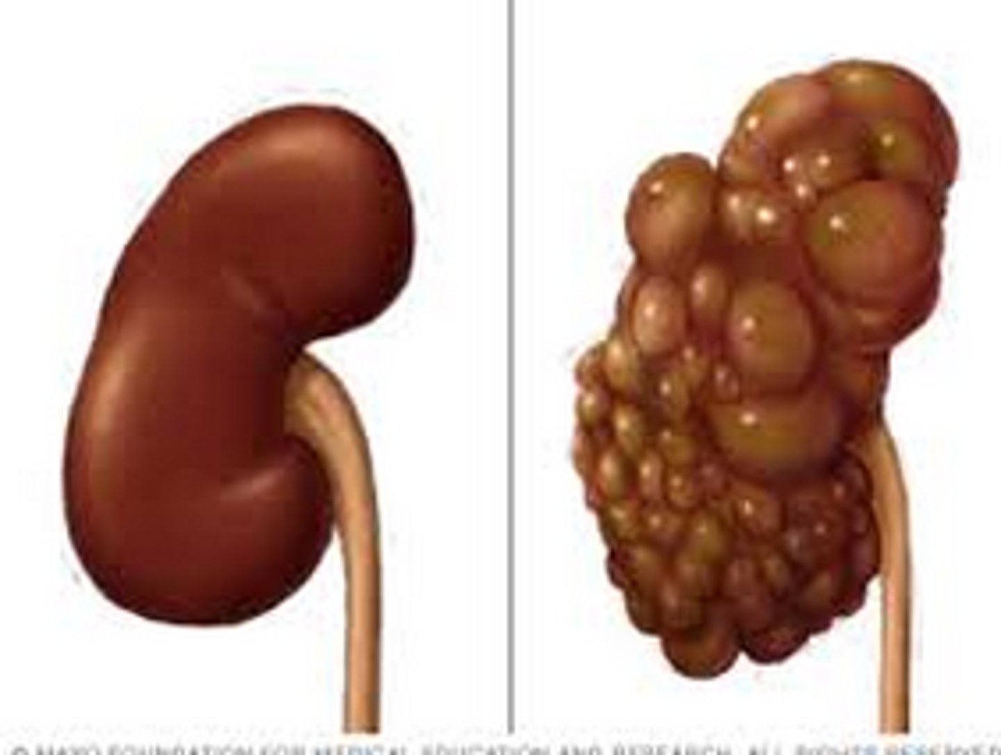 <p>- It is conditioned as an Infantile form: enlarged kidneys, leading to respiratory problems and congestive heart failure.</p><p>- Those who are at risk 1 in 1,000</p><p>- It can be done through Kidney transplants</p>