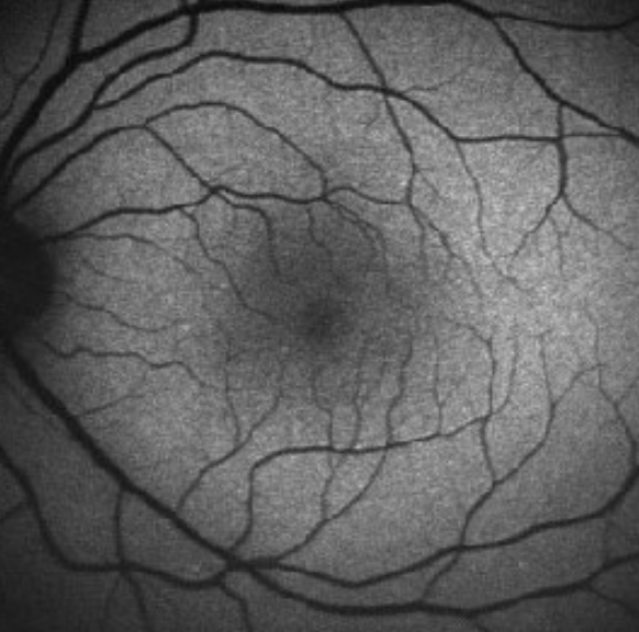 <ul><li><p>Bright on fundus autofluorescence</p></li><li><p>Peak density in parafovea</p></li><li><p>Toxic to RPE</p></li><li><p>Damages organelle membranes</p></li><li><p>↑ photo-oxidative damage</p></li><li><p>Can mechanically damage cell</p></li></ul><p></p>
