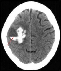 <p>frontal or temporal lobes</p>