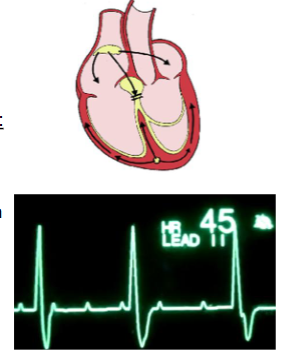 <ul><li><p>3rd degree heart block - no conduction through AV node - atria fire at SA node rate (~75 APs/min), ventricles at bundle/Purkinje rate (~30 APs/min)</p></li></ul><p></p>