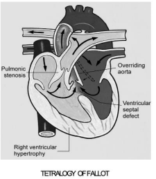 <ul><li><p>Ventricular spetal defect </p></li><li><p>Overriding aorta </p></li><li><p>Pulmonary stenosis </p></li><li><p>RV hypertrophy </p></li></ul><p></p>