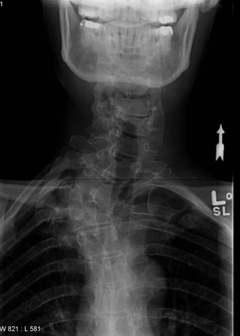 <p>Failure of development of a lateral ossification center; isolated wedged vertebra causes a scoliosis; associated with gibbus deformity </p>