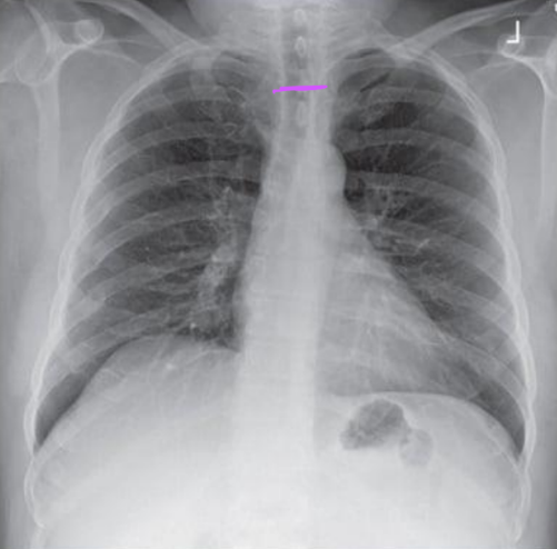 <ul><li><p>Lungs and heart are foreshortened</p></li><li><p>Horizontal clavicles</p></li><li><p>Manubrium at T1-3</p></li><li><p>Less than 1” of the apices</p></li><li><p>Ribs are more horizontal</p></li><li><p>MCP titled away from IR</p></li></ul><p></p>