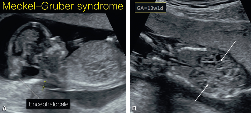 <p>Meckel–Gruber syndrome, which is a fatal disorder that includes renal cystic disease, occipital encephalocele, and polydactyly</p>