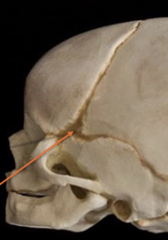 <p>closes at around 6 months</p><p>becomes pterion</p>