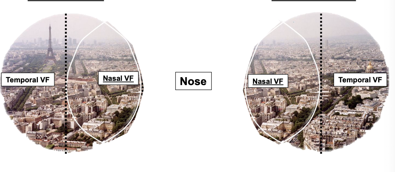 <ul><li><p>visual field for each individual eye can also be described as a temporal VF or a Nasal VF </p></li></ul><p></p>