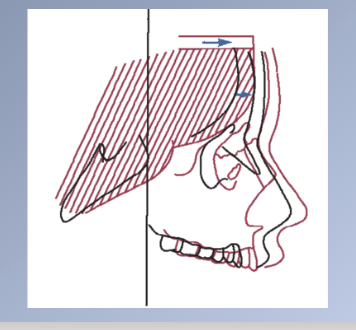 <p><span>Passive displacement by growth of the cranial base</span><br><span>1. Important growth mechanism during the primary dentition years</span><br><span>2. Less important as growth at the synchondroses of the cranial base slows markedly with the completion of neural growth at age +7.</span><br><span>3. Between ages 7-15, about one third of the total forward movement of the maxilla can be accounted for on basis displacement.</span></p>