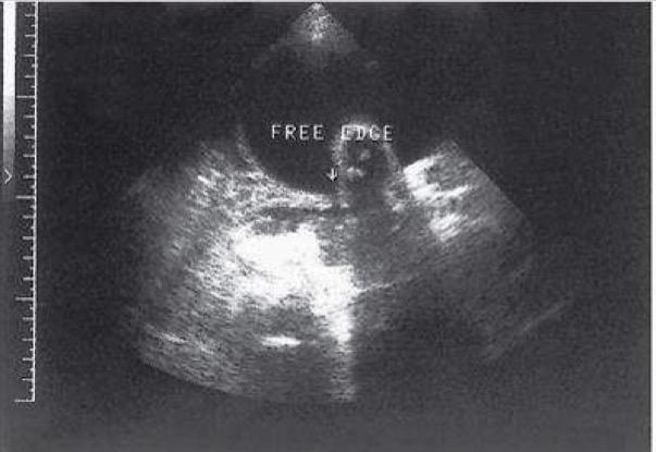 <p>Membranes formed from scarring or adhesions secondary to surgery or infection; extend from uterus with amnion and chorion growing around them; synechiae do not attach to embryo/fetus; not common</p>
